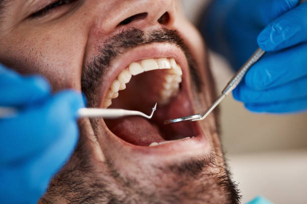 Best Knocked-Out Tooth (Avulsed Tooth) Treatment in South Greeley, WY